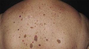 Dermal lesions on the back (seborrheic keratoses).