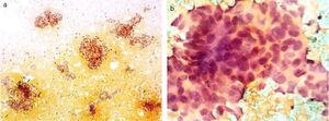 Cytology obtained through fine-needle aspiration biopsy. a) Panoramic view with three-dimensional conglomerates of overlapping cells. b) The close-up shows syncytium cells with overlapping and nuclear hyperchromasia, scant cytoplasm, thick and coarse chromatin, as well as some atypical mitoses and moderate anisokaryosis.