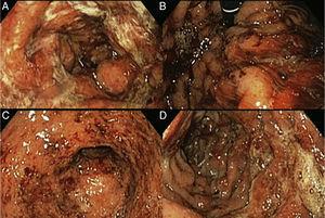 A) Gastric mucosa with edema, erythema, and mucopurulent exudate. B) Retrograde view of the stomach showing oozing hemorrhage. C) Open edematous pylorus covered with mucopurulent exudate and blood flecks. D) Duodenum with friable edematous folds and mucosa, with erosions covered with mucopurulent exudate and blood flecks.
