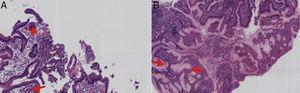 A) Biopsy of the gastric mucosa with microabscesses. B) Foveolar hyperplasia and luminal inflammatory infiltrate.