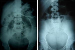 Plain abdominal x-ray in decubitus with dilatation and centralization of the small bowel segments and air-fluid levels in the standing projection.