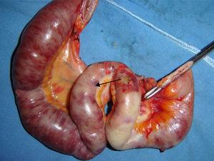 The indurated intestinal zone with edema, clear signs of ischemia, and areas of serous necrosis, with an obvious reduction in the size of the intestinal lumen is shown.