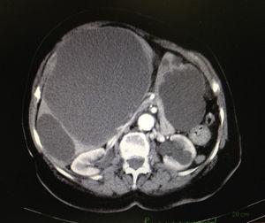 Abdominal computed tomography scan showing voluminous hepatic cysts.