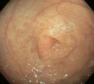 Endoscopic image of a patient with CMPA that shows erythema of the mucosa at the level of the antrum.