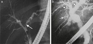 a and b. Cholangiographic images typical of PSC with filiform strictures (long arrow) and saccular dilations (short arrows) with “beaded pattern”.