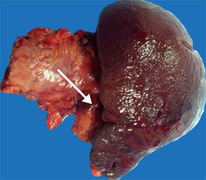The surgical specimen from the distal pancreatectomy with splenectomy. The tip of the arrow points to a 2.8 x 2.1cm lesion toward the tail of the pancreas.
