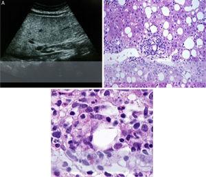A. Hepatosplenomegaly and severe steatosis (grade 3) without dilated biliary ducts. B. Steatohepatitis with severe activity and mild fibrosis (Brunt-Kleiner 3). C. Photomicrography showing satellitosis (adipocyte surrounded by neutrophils and some eosinophils, x40).