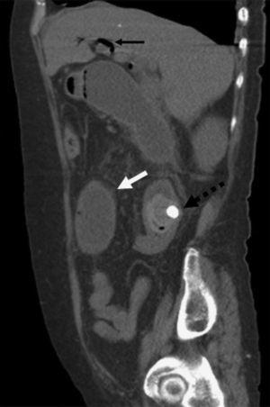 Sagittal view of the abdominal tomography scan in which Rigler's triad can be seen, along with bowel segment dilation (white arrow), pneumobilia (black arrow), and the ectopic gallstone in the proximal jejunum (black dotted arrow).