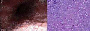 A) Aspect of endoscopy performed before PPI treatment, showing edema, erythema of the mucosa, with a whitish mottled pattern and exudates. B) Aspect of the esophageal mucosa biopsy before PPI treatment. Note the large quantity of eosinophils infiltrating the epithelium. The count was 18 to 52 per HPF.