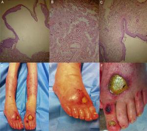 A-C) Histologic slides showing a subepidermal blister with a mixed superficial perivascular inflammatory infiltrate consistent with bullous pemphigoid; D-F) These images correspond to dermatologic lesions made up of large, denuded blisters with a fibrin-covered base, some of which have necrotic edges.