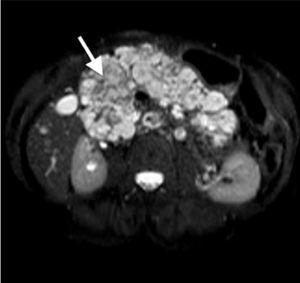 Abdominal MR images showing an enlarged pancreatic gland with multiple cystic lesions in its interior distributed in the head, body, and tail.