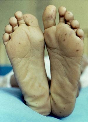 Disseminated plantar lentigines associated with Peutz-Jeghers syndrome.