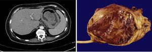 Case 2. The abdominal CT reported a pedunculated neoplastic lesion dependent on the gastric fundus. The surgical specimen showed an IFP of 9.1×6.3cm.