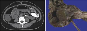 Case 4. The abdominal CT revealed a double-wall morphology indicative of intussusception of the ileum into the ascending colon. The surgical specimen reported an IFP in the ileum of 7.2×3.8cm and ileal intussusception.