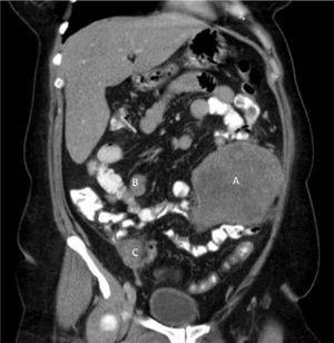 Contrast-enhanced coronal computed tomography multiplanar reconstruction in the venous phase showing a mass with no calcification with heterogeneous enhancement in the left hemiabdomen adjacent to the jejunal segments (A). Notice the metastatic satellite lesions with similar characteristics (B and C).