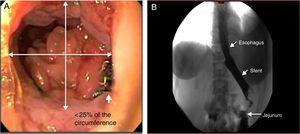 A) The endoscopic image shows the leakage site. B) The x-ray shows the esophageal stent with no contrast agent leakage.