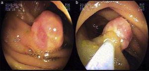 Double-balloon enteroscopy. a) Jejunal lesion 15mm in diameter, and b) Injection at the base of the lesion.
