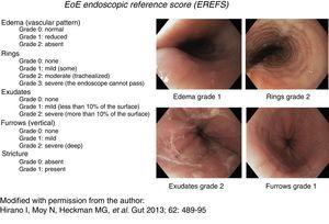 Endoscopic reference score for eosinophilic esophagitis with examples. Modified with permission from the author, from Hirano et al., 14.