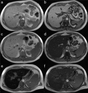 Image of the liver in the in-phase (left column) and out-of-phase (right column) T1 sequence in 3 different patients. In a normal patient, the signal is similar in the a) in-phase and b) out-of-phase sequences. The images in the center are those of a patient with steatosis in whom the intensity of the parenchymal signal is normal in the “in-phase” sequence (c) and it markedly decays in the “out-of-phase” sequence, where it acquires a tone of black due to the greater fat content (d). The bottom row corresponds to a patient with hemochromatosis. The signal decays in the “in-phase” sequence (e), due to the increase in iron saturation, compared with the “out-of-phase” sequence (f).