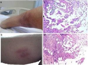 a and b) Image of the lower limb showing painful, purplish, erythematous, subcutaneous, nodular lesions consistent with panniculitis, some with oleous secretions. c and d) Pathologic anatomy image (hematoxylin-eosin) of cutaneous lesions showing fibrosis covering some fatty zones with inflammatory cells and other histiocytes, as well as areas of non-cellular amorphous basophilic material. Fat necrosis with difficult-to-distinguish adipocytes and microcalcifications can be seen in other areas.