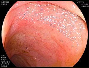 Duodenal nodular mucosa with atrophic aspect.