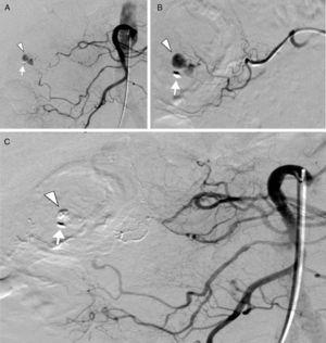 A) Selective digital subtraction angiography of the superior mesenteric artery that shows the presence of contrast extravasation (arrowhead) from the vasa recta of a distal arcade of the right colic artery, next to the only remaining endoscopic clip (arrow). B) Super-selective catheterization of the distal arcades of the right colic artery with contrast extravasation from the vasa recta (arrowhead) near the endoscopic clip (arrow). C) Final selective digital subtraction angiography of the superior mesenteric artery that shows the complete exclusion of the vasa recta of a distal arcade of the right colic artery embolized by n-butyl cyanoacrylate with the absence of contrast extravasation (arrowhead) near the endoscopic clip (arrow).