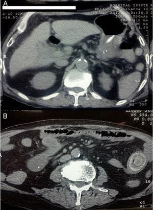 A) Axial view of non-contrasted abdominal tomography scan (Patient No.1 with bowel obstruction), non-visible gallbladder, and pneumobilia. B) lower axial view showing the calcified intraluminal stone.