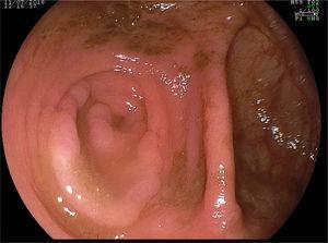 Endoscopic aspect of the serrated polyps. Flat polyp located in the appendicular orifice.