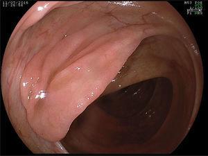Serrated polyp located in the ascending colon. Vascular pattern loss is a characteristic unique sign of the presence of a serrated polyp.