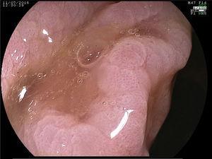 High-resolution white light image and its magnification after performing chromoendoscopy with acetic acid. A glandular pattern characteristic of the II-O open serrated adenomas described by Kimura et al. is shown.