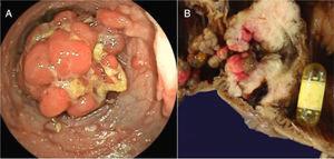 A) Colonoscopy showing the presence of a large polyp. B) Surgical specimen that shows the intestinal lumen with countless polyps and the video capsule obstructing the lumen at the stenosed zone in the ileum.