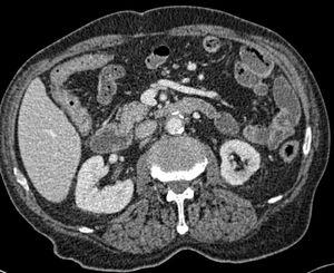Abdominal CT scan showing the proximal aortic graft in close relation to the wall of the small bowel.