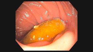 Esophagogastroduodenoscopy confirmed aortoenteric fistula.
