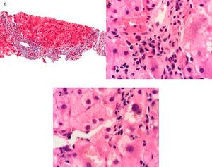 Masson stain at x40 shows grade III fibrosis due to the presence of portal-portal bridging fibrosis a). Hematoxylin & eosin stain at x100 shows interface hepatitis due to the presence of a lymphoplasmacytic inflammatory infiltrate overlapping the limiting plate b) and chronic lobular hepatitis due to the presence of a lymphoplasmacytic inflammatory infiltrate, hepatocyte vacuolation, and intra-cytoplasmic cholestasis in the hepatic lobule c).