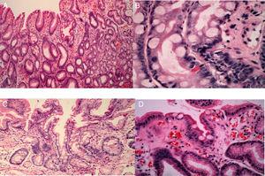 Histologic images of gastric intestinal metaplasia. A) Focal incomplete intestinal metaplasia: goblet cell (bold arrow), brush border enterocytes (thin arrow), and normal foveolar epithelium (cross). B) Complete intestinal metaplasia: goblet cell (thin arrow), enterocyte (bold arrow), and Paneth cell (short arrow). C) Complete intestinal metaplasia: goblet cell (thin arrow), enterocyte (long arrow), and Paneth cell (wide arrow). D) incomplete intestinal metaplasia: enterocytes (thin arrow), goblet cell (bold arrow), and foveolar epithelium (cross).