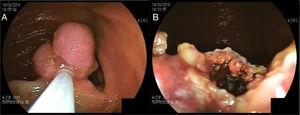 A) Polyp in the small bowel before resection and B) after resection.