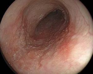 White light endoscopy of the early esophageal lesion.