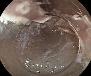 Endoscopic dissection of the submucosa.