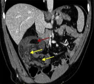 Abdominal CT coronal reconstruction that shows the head of the invagination, corresponding to a lipoma (red arrow) and the large ileocolic invagination with vessels and mesenteric fat inside the lumen of the colon (yellow arrows).