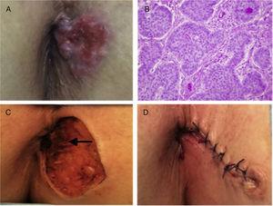 A) Perianal erythematous papular lesion with pearly nodules and superficial ulceration. B) Histopathologic study: Basaloid cell nests with peripheral palisading on top of subepidermal loose connective tissue, consistent with nodular basal cell carcinoma (H&E x40). C) Detail of the surgical site after resection, showing the absence of infiltration into the sphincteric musculature (arrow). D) Aspect of the operating area after surgical reconstruction.