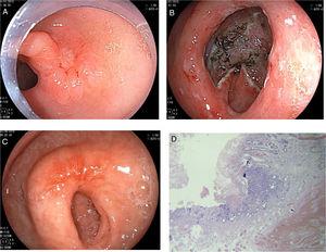 Endoscopic submucosal dissection (ESD) of pre-pylorus lesion. A) Slightly depressed lesion with 2-cm elevated edges, poorly defined edges, and irregular surface. B) Final result of the submucosal dissection. C) ESD scar 8 weeks after the procedure. D) Intramucosal well differentiated adenocarcinoma with disease-free surgical edges.