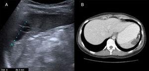 A) Postoperative abdominal ultrasound: a well-defined, anechoic, polylobulated lesion with echogenic internal septa in the interpolar region of the spleen, measuring 32mm in diameter, consistent with a cystic remnant. B) Computed tomography scan: altered splenic contour with a 22 x 23mm uniform hypodense lesion consistent with a postoperative cystic remnant.