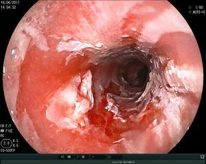Upper GI endoscopy showing congestion and circumferential sloughing of the entire mucosa of the distal third of the esophagus.