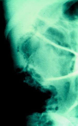 Radiologic image showing pneumatosis in the cecum in greater detail.