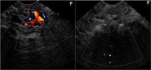 Endoscopic ultrasound with Doppler showing the IGV-1 before and after endoscopic treatment.