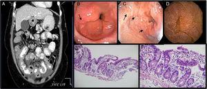 A. Ascites, diffuse and concentric thickening of the small bowel. 1B and 1C. UGIE with changes suggestive of eosinophilic esophagitis and duodenitis. 1D. Capsule endoscopy: mucosa with edema and erythema that produces thickening of the villi. 1E Ileum (H&E-x100). Preserved ileal mucosa with slightly enlarged and flattened villi with lymphocytic inflammatory infiltrate, the presence of a greater number of eosinophils and crypts with some branches. 1F. Ileum (H&E-x400). Ileal mucosa at a greater magnification showing a larger number of lymphocytes and eosinophils than usual in the lamina propria, which carry out exocytosis into the superficial epithelium and crypts.