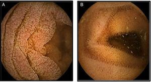 Capsule endoscopy. 2A. Mucosa with edema and erythema, that produces thickening of the villi. 2B. Control showing the disappearance of the edema and erythema, with normalization of the thickness of the villi.
