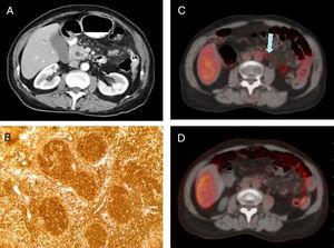 A) Intravenous contrast-enhanced abdominal CT scan (5-mm axial slice) showing the thickening of the head of the pancreas and dilation of the choledochus. B) Histopathologic study of peripancreatic adenopathy and positive bcl-2, consistent with follicular lymphoma. C) PET/CT (axial view): adenopathy in the hyperenhanced mesenteric root (arrow). D) Control PET/CT after treatment with rituximab (axial view): disappearance of metabolic activity in the adenopathy of the mesenteric root.