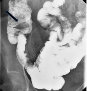 Bowel transit: filling defect in the cecum suggestive of the presence of a tumor (black arrow).