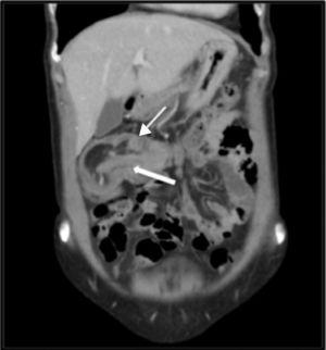 Coronal view of the abdominal CAT scan: invagination of the ileum (thick arrow) in the transverse colon (thin arrow). «Sausage-shaped» mass.